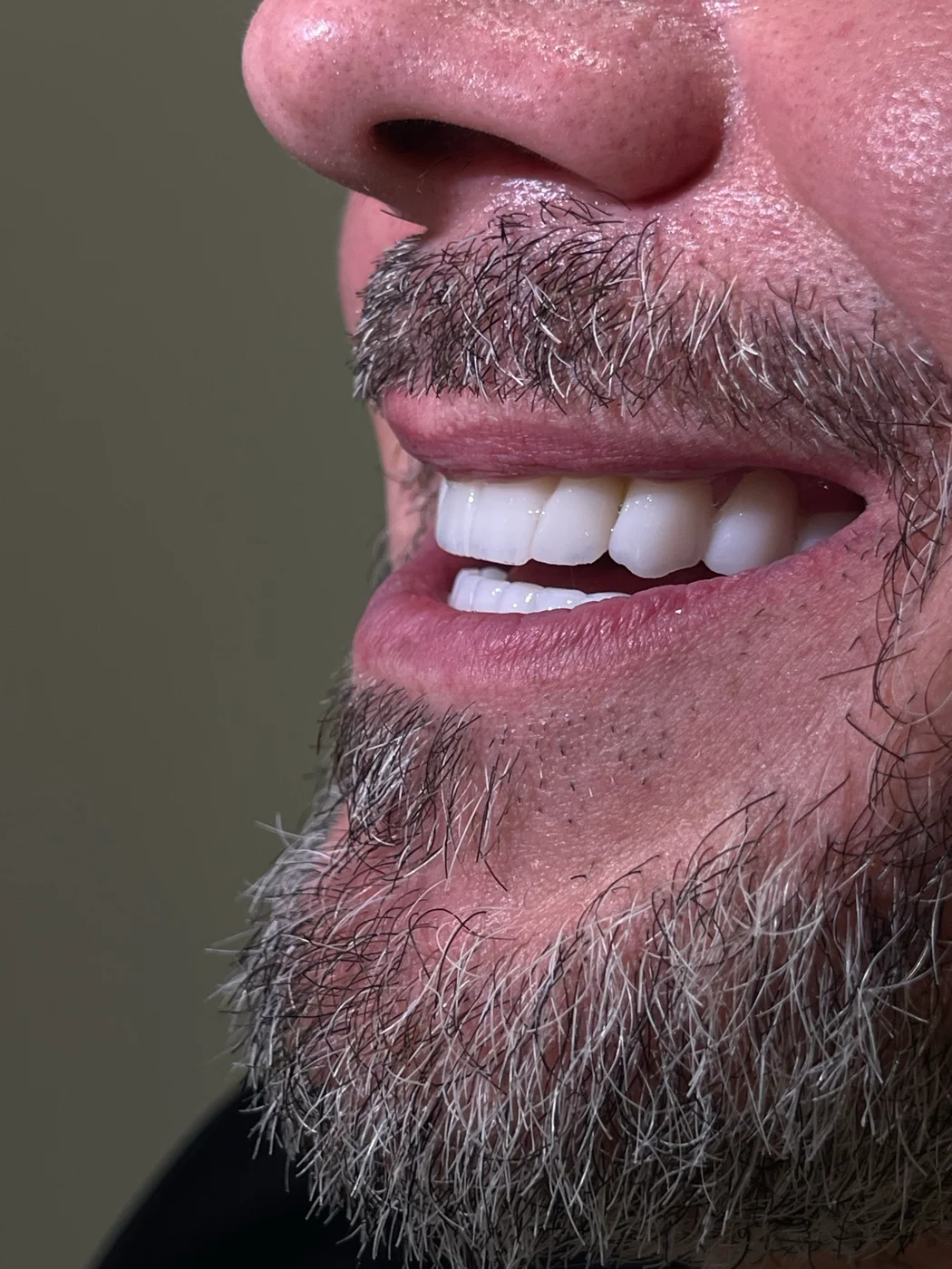 Impianto singolo, dente frontale