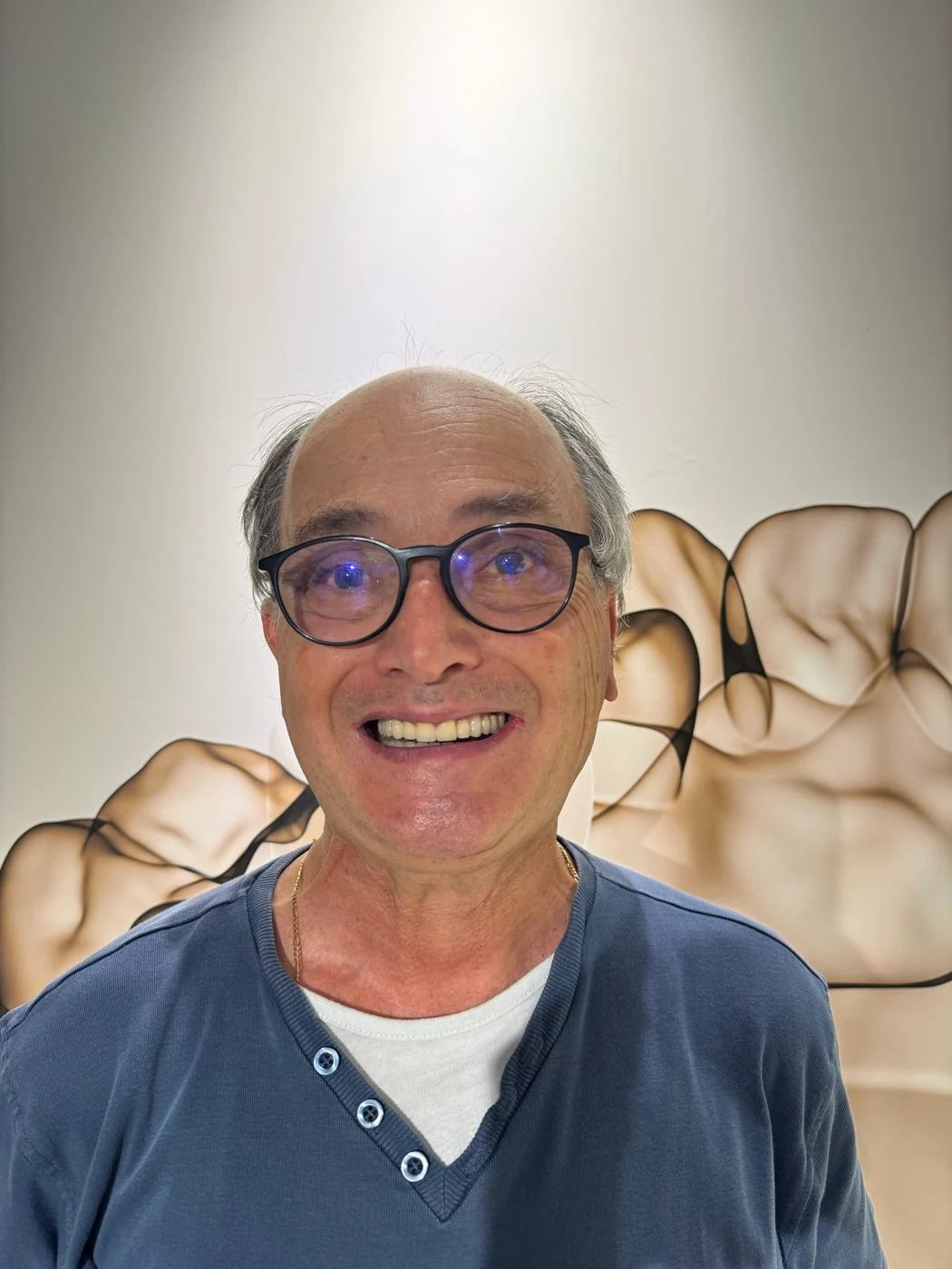 Chiusura di diastema con faccette